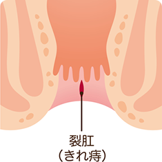 裂肛（きれ痔）